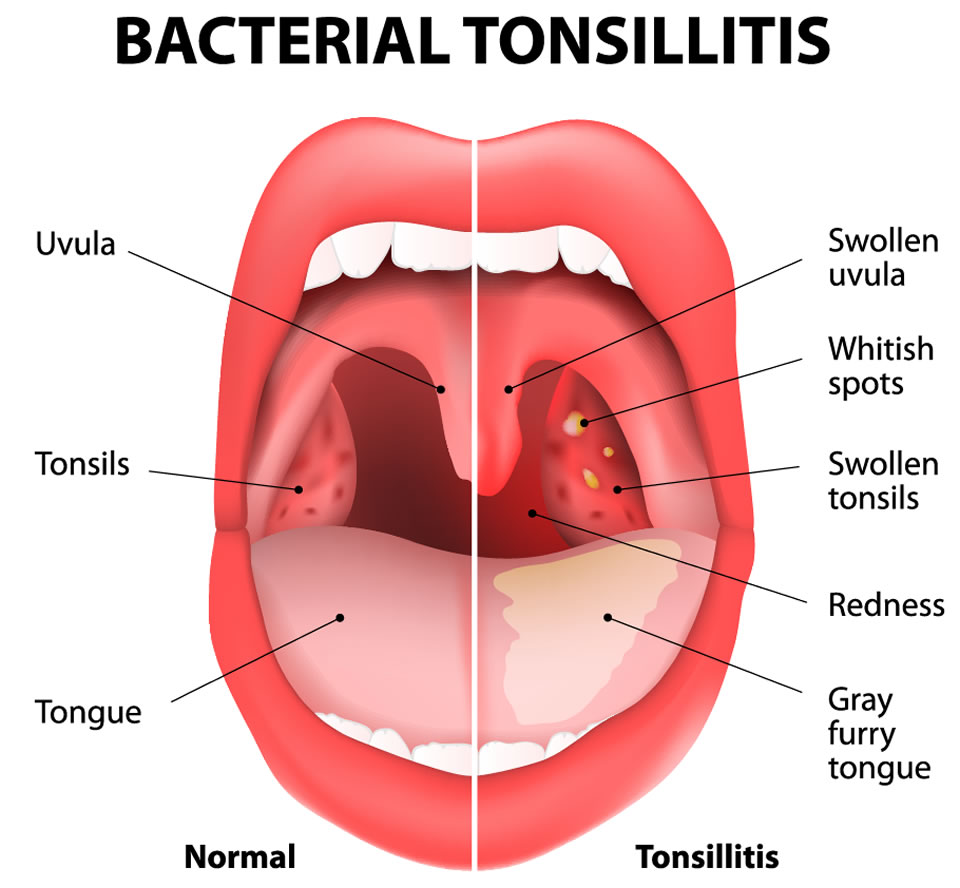 Bacterial Tonsillitis