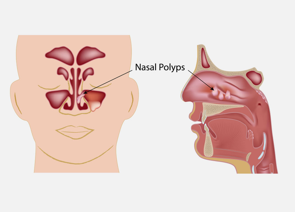 Nasal Polyps