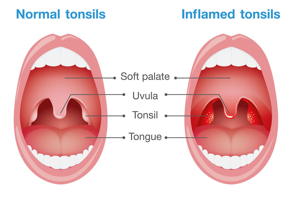 Normal Tonsils and Inflamed Tonsils