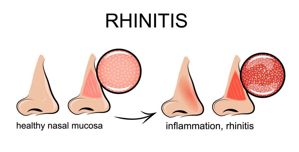 Rhinitis Diagnosis