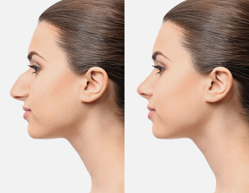 Rhinoplasty Diagnosis