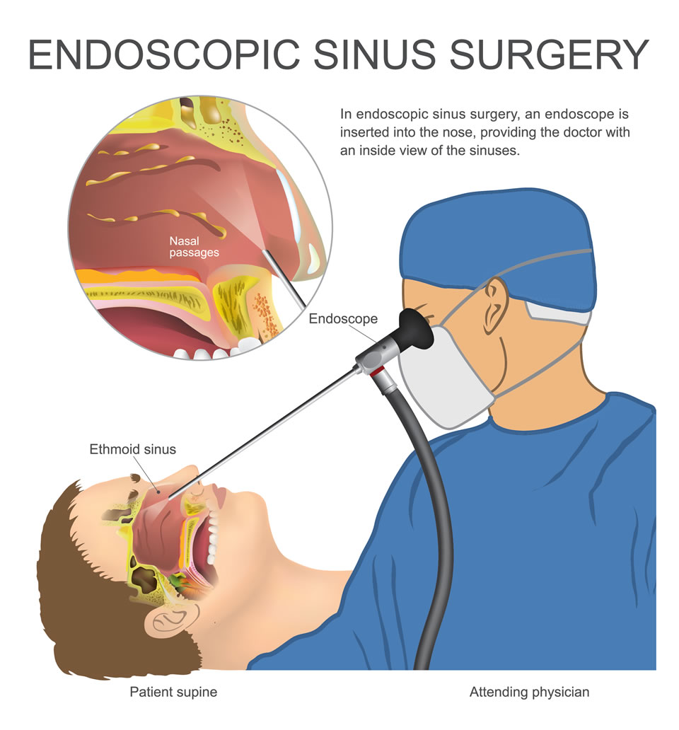 Sinusitis Diagnosis