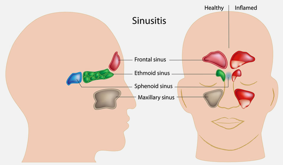 Sinusitis