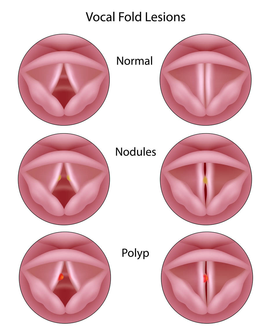 Vocal Cord Lesions